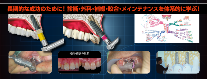 難しい下顎ケースでの正確なピンポイント埋入を可能にする皆川式インプラント