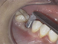 �`�`�[���A�g�����^ Excellence in Dental Implants �V���[�Y�`<br>���������{�^�V���O�����Z�O�����g(���i�ԍ� DE86-S�j