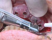 �`�`�[���A�g�����^ Excellence in Dental Implants �V���[�Y�`<br>�����{�F�I�[�o�[�f���`���[�ƃA���J�[(���i�ԍ� DE87-S�j