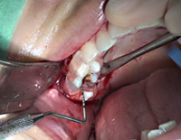 ステップアップ！歯科外科手術　応用編１<br/>「 インプラント オペの基本　上顎 編 」（全２枚・分売不可）(商品番号DE112-S)