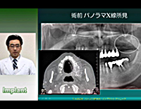 口腔外科医と学ぶ「フィクスチャー埋入術」<br>〜どうする?ソケットリフト法による上顎インプラント治療〜(全1枚)<br>(商品番号DE115-S)
