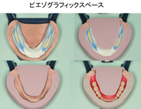 鶴見大学先制医療研究センター 医療技術トレーニングシリーズ<br>高精度全部床義歯の製作<br>〜 ピエゾグラフィーとFBIテクニック 〜(全1枚)(商品番号DE116-S)