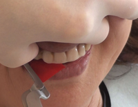 リテーナー義歯の臨床<br>〜歯を抜かずに咬合を保持する！咬合補綴の実際〜<br>【全１巻】(商品番号DE138-S)