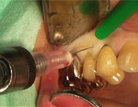 ステップアップ！歯科外科手術　基本編２<br>「麻酔、切開・剥離、縫合」のテクニック(商品番号DE97-S)