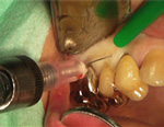 ステップアップ！歯科外科手術　基本編２「麻酔、切開・剥離、縫合」のテクニック