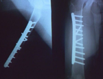 Dr.ペローの 『 整形外科手術テクニック 』〜 イヌの大腿骨骨折の内固定法 〜【全1巻】